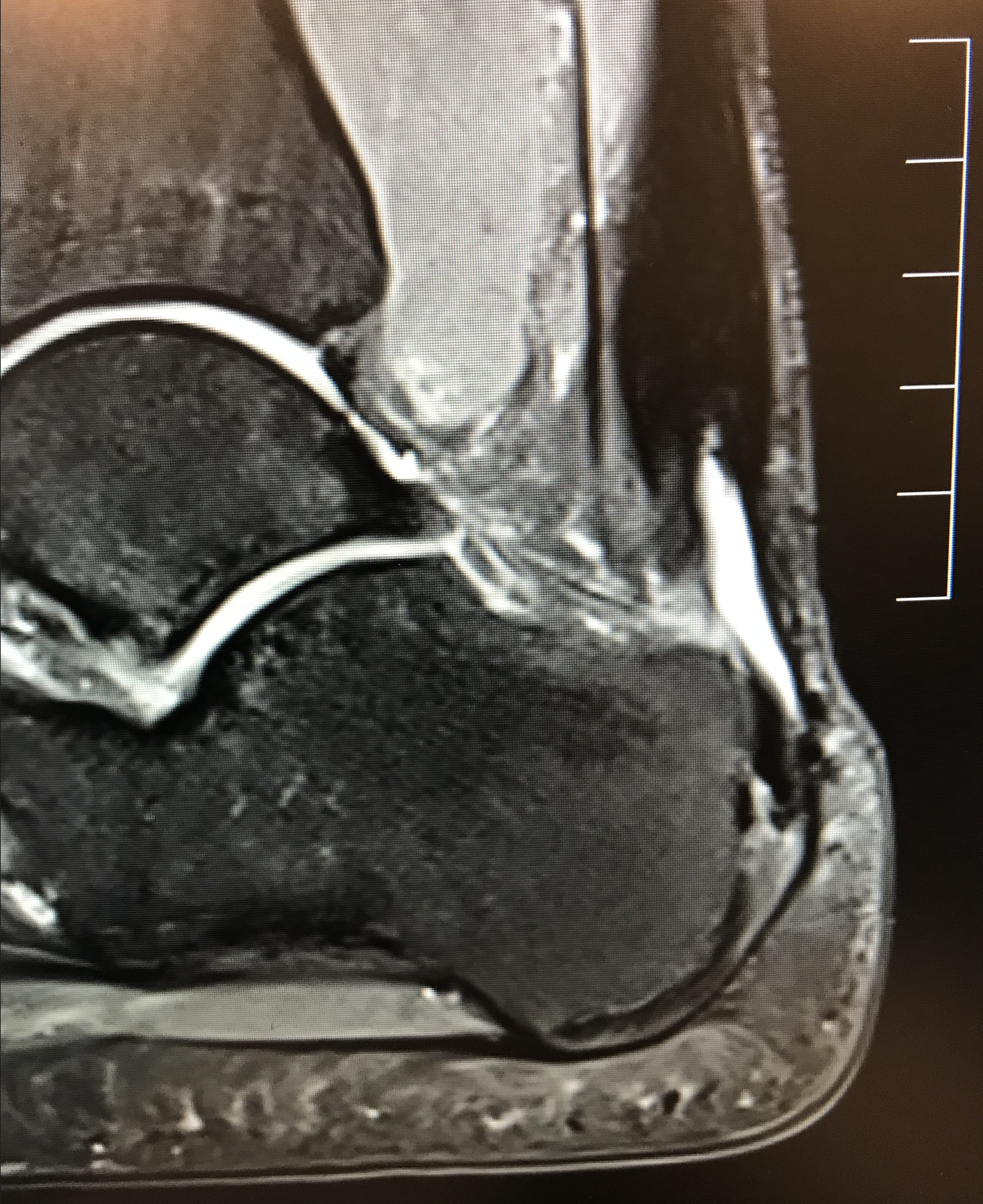 Achilles Tendon Rupture & Reconstruction | David Redfern Surgery
